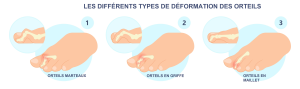 differences-orteils-marteaux-griffes-maillet