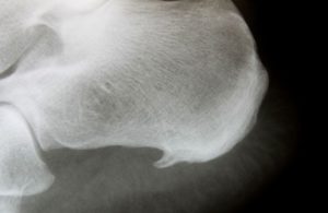 L'épine calcanéenne est visible à la radiographie.