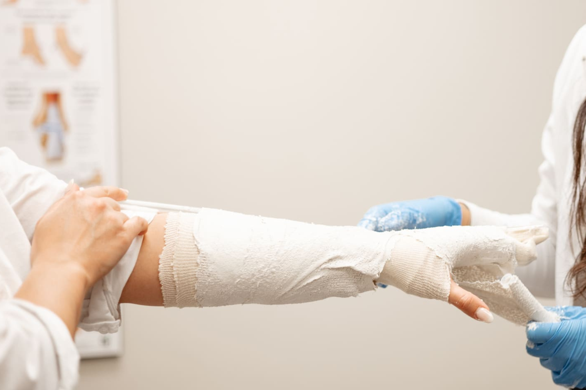 Professionnelle de la santé confectionnant un platre sur le bras d'un patient, pour traiter le syndrome du tunnel carpien